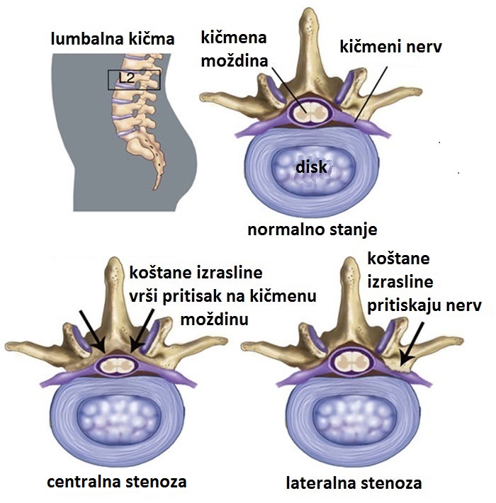 Spinalna stenoza